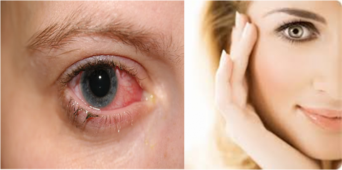 Hạ khô thảo hỗ trợ điều trị bệnh đau mắt đỏ và làm sáng mắt