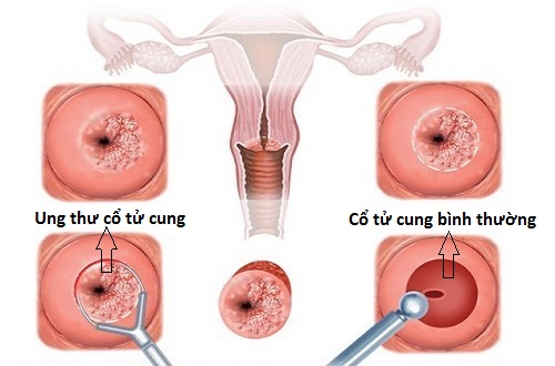 Ung thư cổ tử cung thường được phát hiện ở giai đoạn muộn