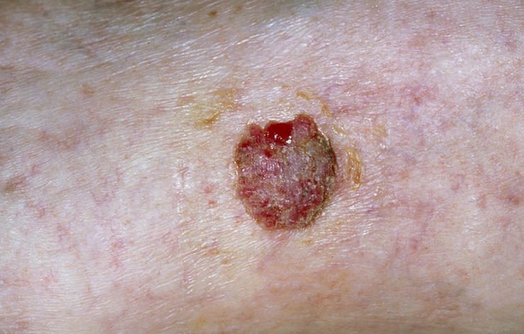 Đau, ngứa da – dấu hiệu của ung thư da