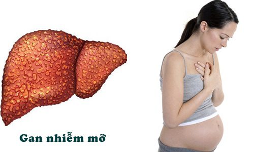 Gan nhiễm mỡ khi mang thai rất nguy hiểm cho thai phụ và thai nhi