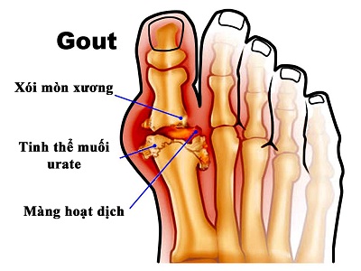 Tác dụng của nấm lim xanh đối với bệnh gout