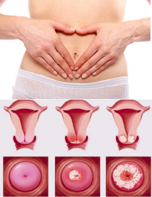 Phòng ngừa ung thư cổ tử cung là cách phụ nữ bảo vệ bản thân với vô sinh, giảm ham muốn tình dục.