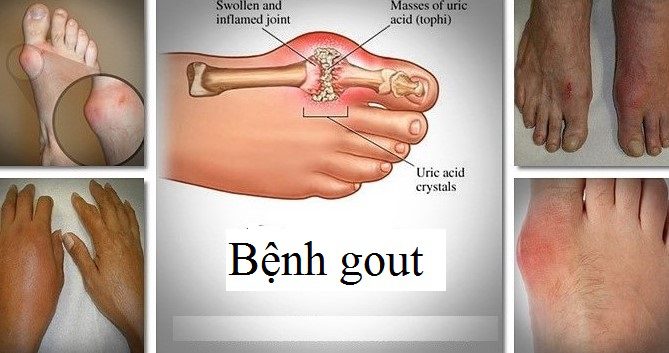 Bệnh gout thường xuất hiện nhiều ở các khớp chân