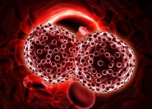 Hình ảnh về bệnh ung thư máu các thông tin lưu ý dành cho người bệnh