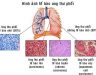 Cách chữa bệnh ung thư phổi giai đoạn cuối - Báo Sức khỏe & Đời sống