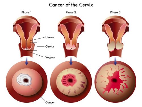 Triệu chứng ung thư tử cung qua các giai đoạn.