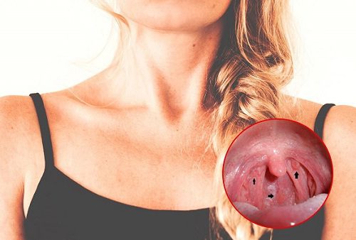 Triệu chứng ung thư vòm họng cơ bản bạn nên biết