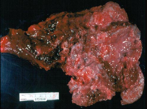 Các tế bào, khối u ung thư tàn phá lá phổi của bệnh nhân.