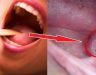 Cách ngăn ngừa ung thư vòm họng hiệu quả bằng 7 cách cơ bản