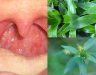 Cây thuốc chữa ung thư vòm họng và cách sử dụng cây lược vàng
