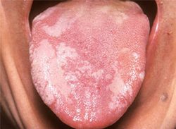 Hình ảnh ung thư lưỡi giai đoạn đầu