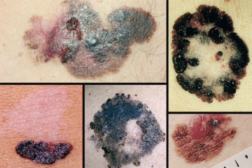 Hình ảnh ung thư da có được từ những triệu chứng bên ngoài