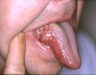 Bệnh ung thư lưỡi giai đoạn đầu và phương pháp điều trị bệnh