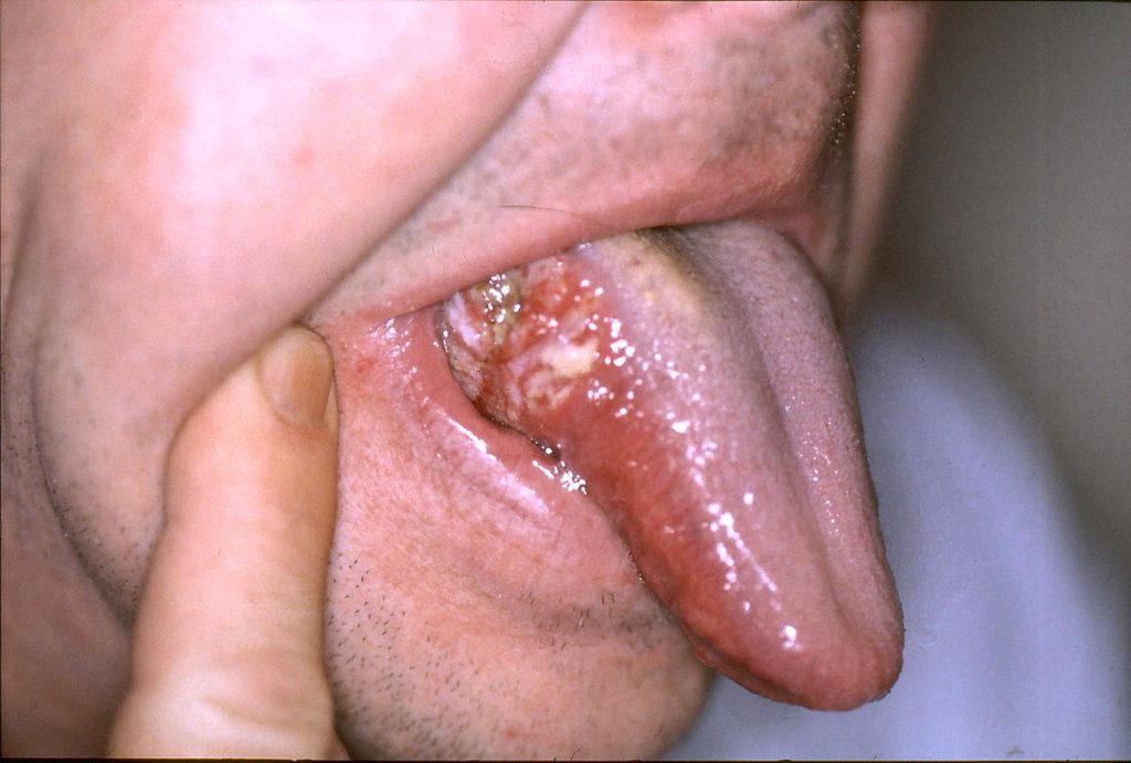 Bệnh ung thư lưỡi giai đoạn đầu  