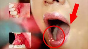 Bệnh ung thư lưỡi giai đoạn đầu có dấu hiệu giống nhiệt miệng