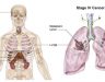 Ung thư phổi di căn não xương được nhận biết và điều trị như thế nào?