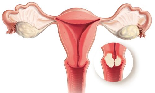 dấu hiệu ung thư cổ tử cung ở phụ nữ