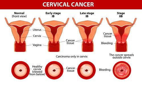 Các giai đoạn phát triển của bệnh ung thư cổ tử cung