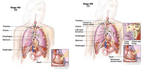 Các giai đoạn ung thư phổi