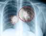 Xét nghiệm tầm soát ung thư phổi để phát hiện bệnh và điều trị