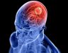 Ung thư não, u não: Dấu hiệu nguyên nhân, điều trị Ung thư não