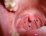 Điều trị bệnh ung thư vòm họng – Nguyên nhân, dấu hiệu nhận biết