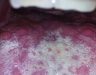 Hình ảnh ung thư lưỡi giai đoạn đầu. Ung thư lưỡi có chữa khỏi được không?