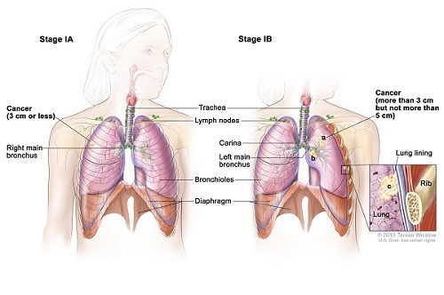 Hình ảnh của bệnh ung thư phổi giai đoạn đầu
