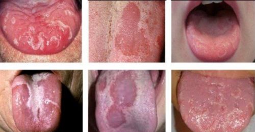 Các hình ảnh về bệnh ung thư lưỡi