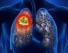 Bệnh ung thư phổi có bị nhiễm không? Phòng chống bệnh ra sao?