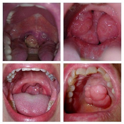 Phương pháp điều trị bệnh ung thư vòm họng