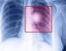 Bị ung thư phổi sống được bao lâu và những điều cơ bản cần biết
