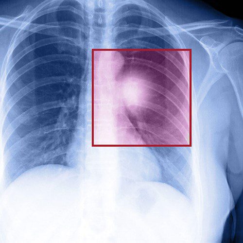 Tìm hiểu bị ung thư phổi sống được bao lâu