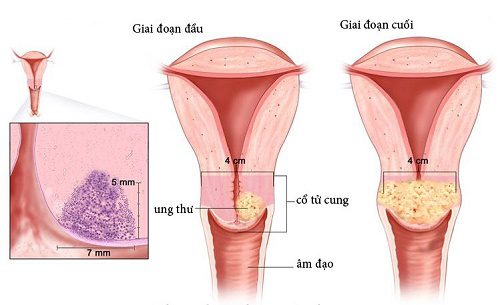 Triệu chứng ung thư cổ tử cung là gì?
