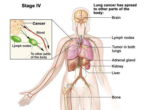 Ung thư gan có thể di căn rất nguy hiểm.
