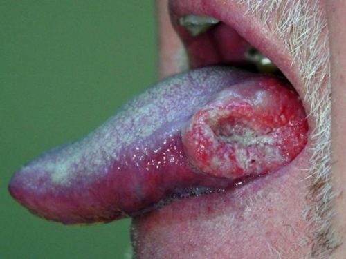 Ung thư lưỡi có khỏi không – điều đó là có thể
