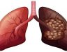 Ung thư phổi có lây qua đường hô hấp không? Cách phòng bệnh tốt?
