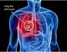 Xét nghiệm tế bào ung thư phổi và những điều bạn cần biết