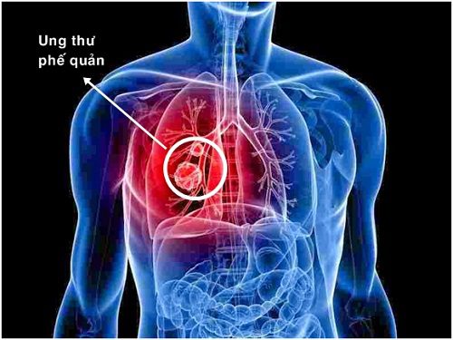 Xét nghiệm tế bào ung thư phổi để làm gì