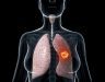 Bệnh ung thư phổi có lây không? Những điều cần biết về ung thư phổi