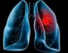 Bệnh ung thư phổi có mấy giai đoạn? Nguyên nhân ung thư phổi
