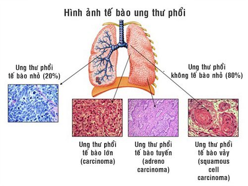 Hình ảnh tế bào ung thư phổi.