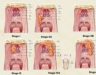 Các giai đoạn ung thư vòm họng? Tiên lượng sống của bệnh nhân ung thư
