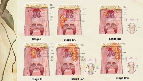 Các giai đoạn ung thư vòm họng