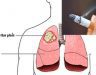 Cách phòng tránh ung thư phổi và cách điều trị hiệu quả nhất