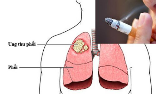 Thuốc lá là một trong những nguyên nhân hàng đầu gây ung thư phổi.