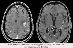 Hình ảnh MRI chụp não của bệnh nhân ung thư di căn não