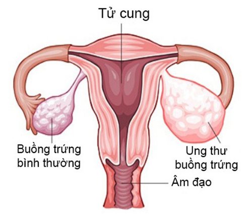 Ung thư buồng trứng là căn bệnh thường gặp ở phụ nữ