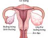 Ung thư buồng trứng giai đoạn 2 - Dấu hiệu nhận biết dành cho bạn gái