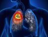 Triệu chứng ung thư phổi: ung thư phổi di căn và cách phòng ngừa